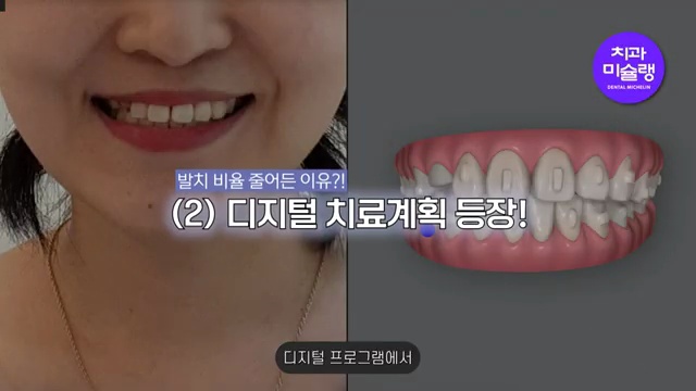 발치 교정, 비발치 교정보다 건강에 안 좋을까? (발치교정 안 하고 싶으시면 필수시청💡🚨)