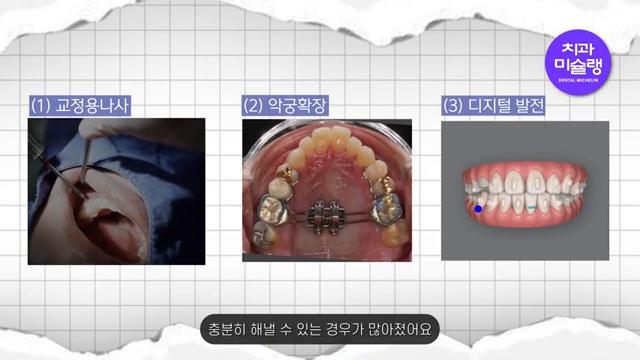 발치 교정, 비발치 교정보다 건강에 안 좋을까? (발치교정 안 하고 싶으시면 필수시청💡🚨)