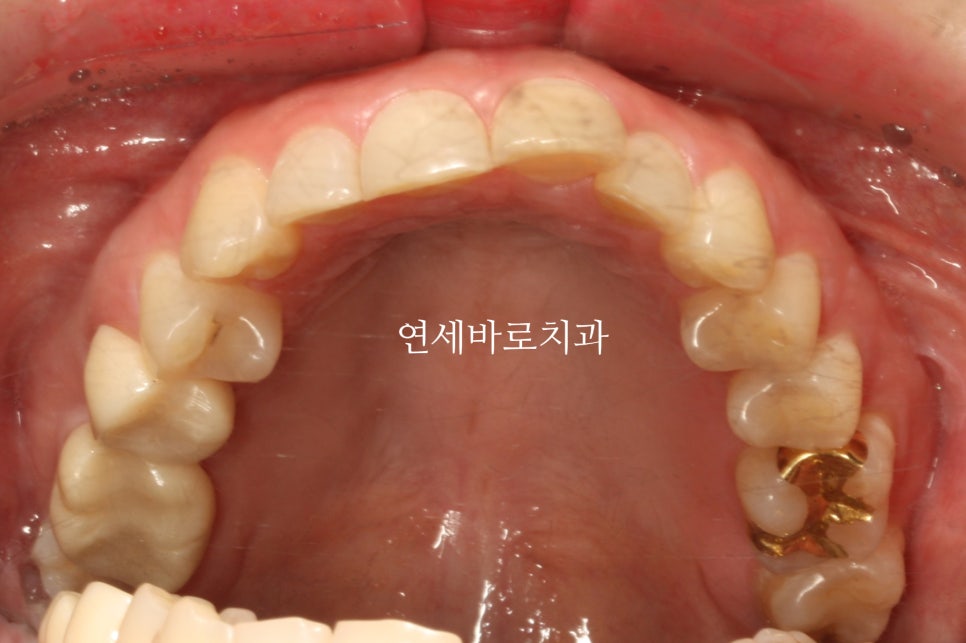 강남 인비절라인 - 인비절라인 교정 치료 비베라 제작까지 (연세바로치과 치과위생사 직원 치료 후기)