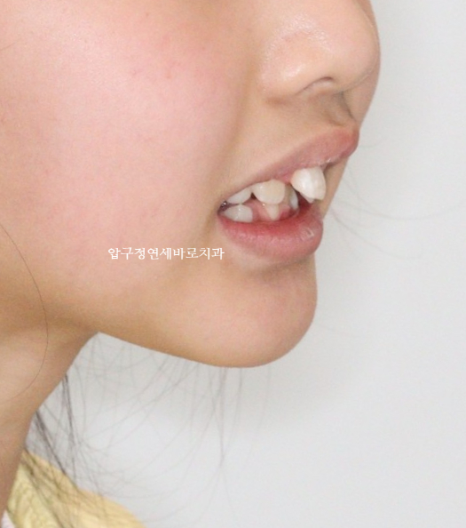 강남 인비절라인 - 앞니 돌출 어린이 교정 #인비절라인퍼스트 치료 후기 중간 기록