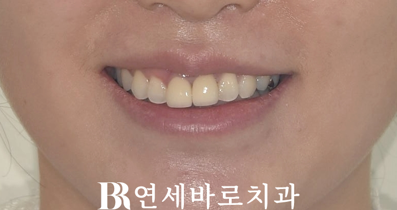 강남 인비절라인 - 무삭제 피팅 라미네이트 젤라미 + 앞니 MTA 부분교정 예비신부 결혼준비 3개월 단기 치료