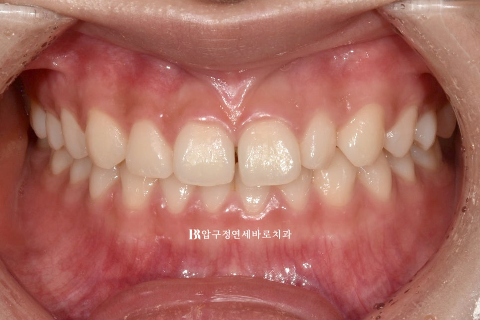 강남 인비절라인 - 벌어진 앞니, 왜소치 잇몸성형 후 무삭제 피팅 라미네이트 치료 기간 부작용 후기