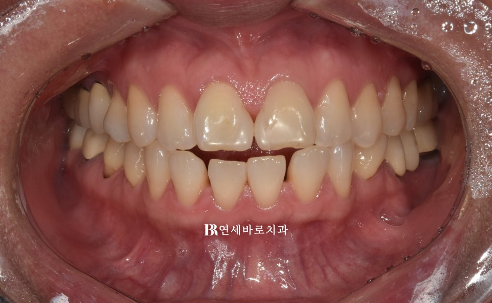 강남 인비절라인 - 인비절라인 라이트 로 어디 까지 커버 가능한가? 벌어진 치아 교정 후기. 선택과 집중