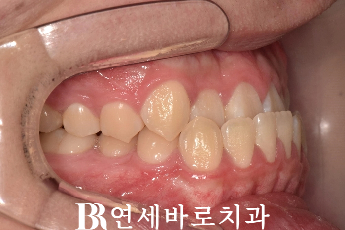 강남 인비절라인 - 양악수술 없이 비수술 주걱턱 교정 가능할까? 집에서 확인하는 자가진단법 압구정 교정치과